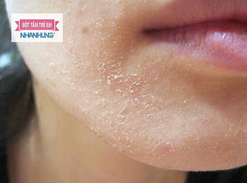 Bệnh viêm da tiết bã là do tuyến bã nhờn hoạt động dưới da mạnh mẽ.