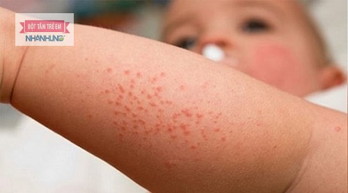 Chứng dày sừng nang lông có thể khiến nổi mẩn đỏ ở chân không ngứa.