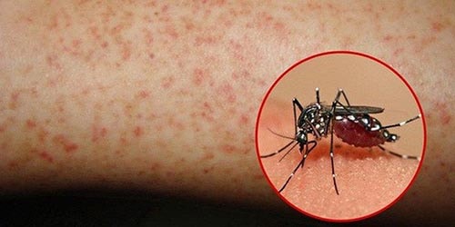 Ở giai đoạn nguy hiểm người bệnh bị xuất huyết dưới da, xuất huyết nội tạng