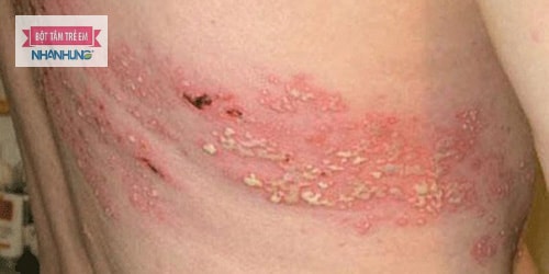 Viêm da tiếp xúc bội nhiễm là biến thể nặng của bệnh viêm da tiếp xúc.