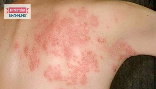 Hệ miễn dịch suy giảm cũng gây ra viêm da tiếp xúc bội nhiễm.