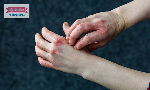 Dấu hiệu bệnh viêm da tiếp xúc bội nhiễm.