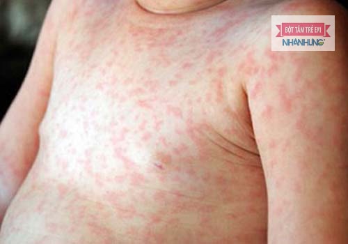 Mề đay là bệnh phổ biến thường gặp ở trẻ.