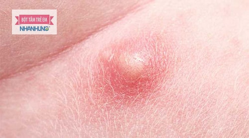 Mụn nhọt ở vùng kín rất dễ nhầm lẫn với bệnh Herpes.