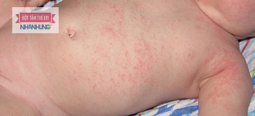 Bệnh mề đay gây nổi mẩn đỏ và ngứa da.