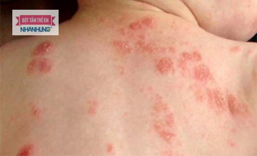 Trẻ em rất dễ bị viêm da do dị ứng hóa chất gây ngứa.