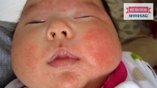 Chàm sữa tái lại nhiều lần – nỗi ám ảnh của nhiều cha mẹ