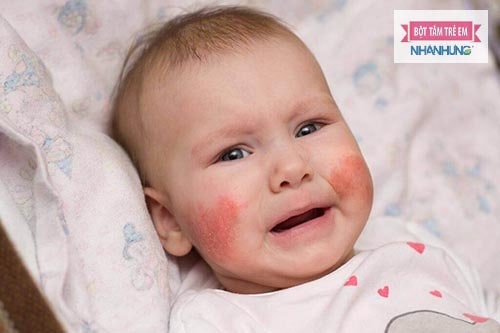 Chàm sữa là bệnh viêm da mạn tính nên rất dễ tái phát