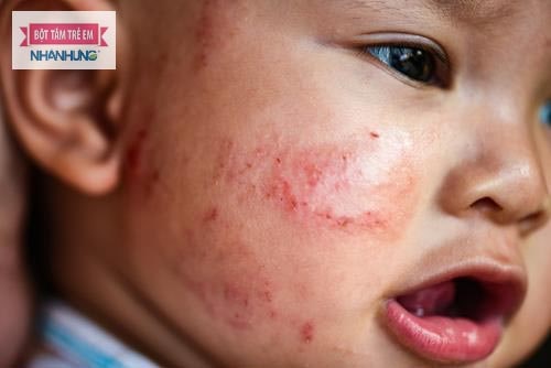 Chàm sữa rất dễ tái đi tái lại nhiều lần