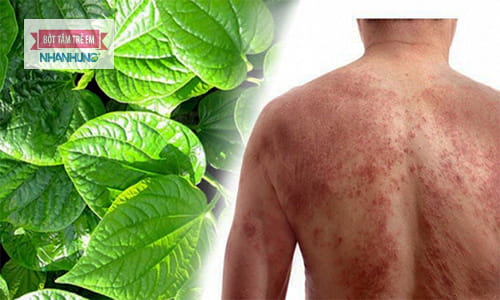 Chữa viêm da cơ địa bằng thuốc nam từ lá lốt.