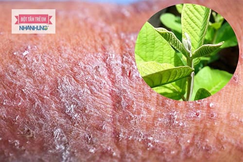 Bài thuốc nam chữa viêm da cơ địa từ lá ổi.