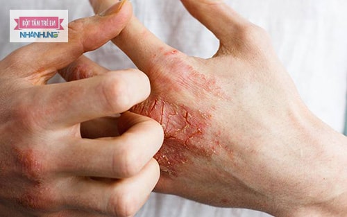 Tiếp xúc với các chất lạ có thể khiến bạn bị viêm da tiếp xúc kích ứng.