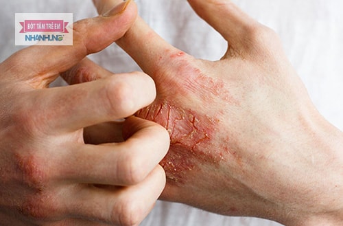 Bệnh viêm da tiếp xúc dị ứng có thể xảy ra khi tiếp xúc với các tác nhân gây dị ứng.