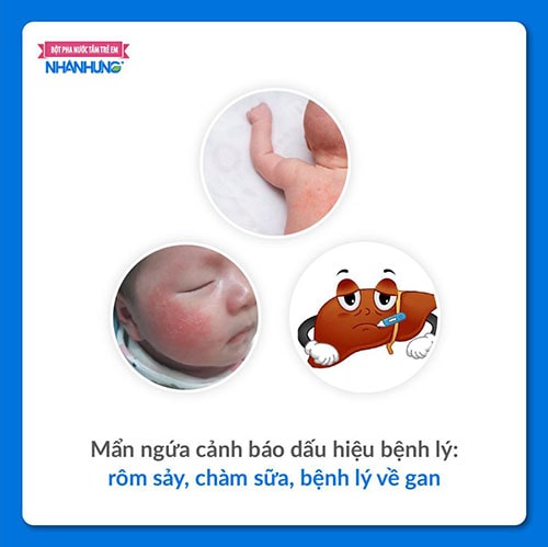 Mẩn ngứa cảnh báo dấu hiệu bệnh lý: rôm sảy, chàm sữa, bệnh lý về gan