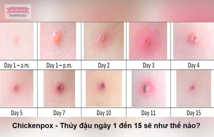 Triệu chứng và dấu hiệu bệnh thủy đậu