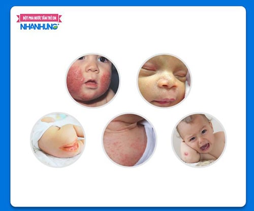 Hoàng liên tác dụng tốt trên các bệnh lý về da