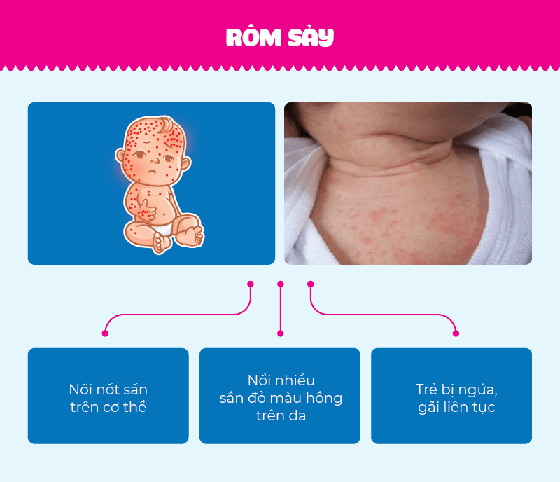 Bệnh rôm sảy mùa hè