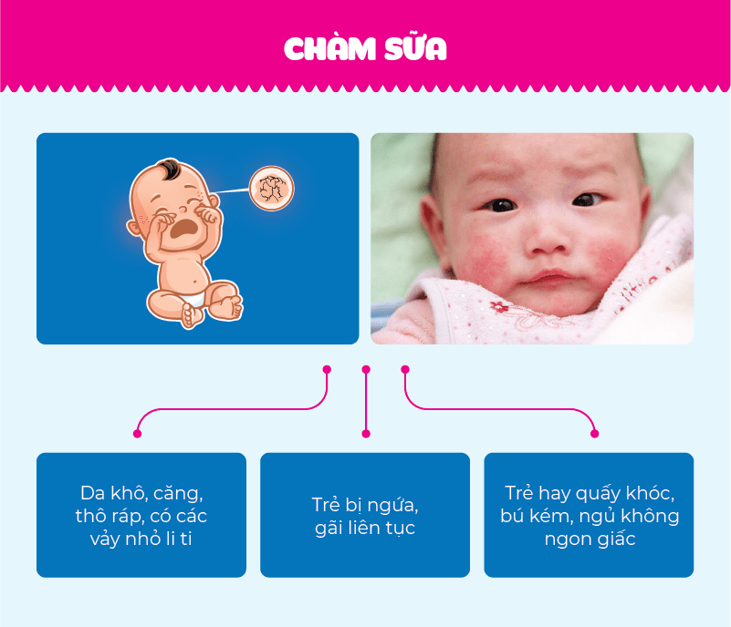 Chàm sữa mùa nắng nóng