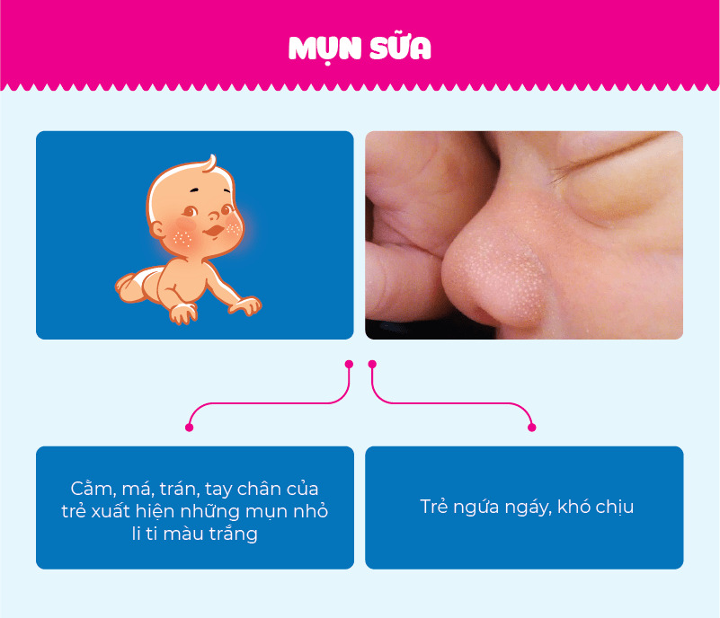 Bệnh mụn sữa