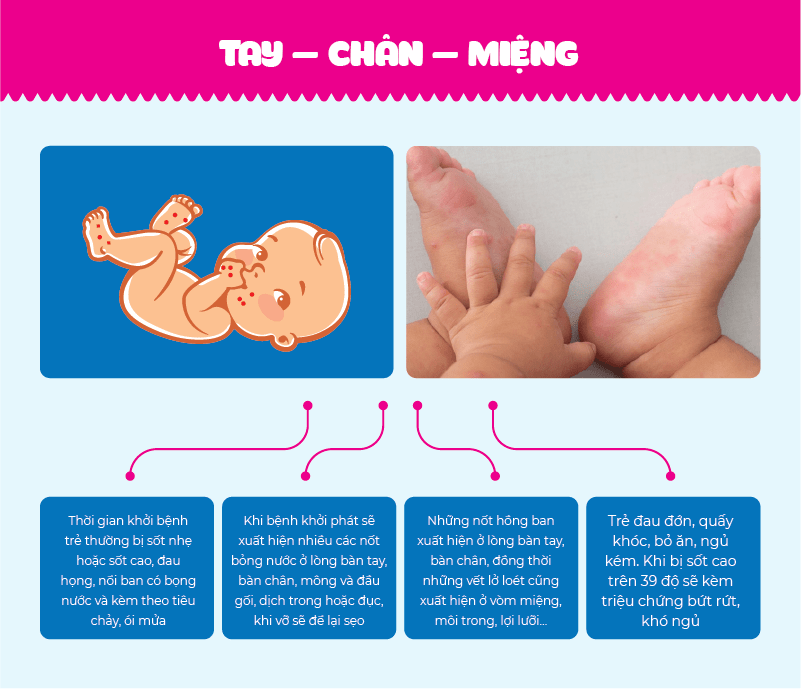 Bệnh tay chân miệng