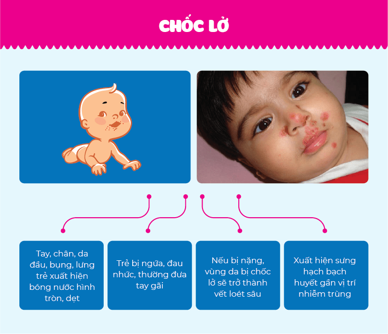 Bệnh chốc lở mùa hè
