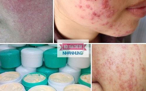Sử dụng kem trộn khiến da bị viêm do nhiễm corticoid.
