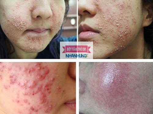 Viêm da do nhiễm corticoid gây tổn thương trầm trọng đến làn da.