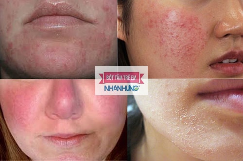 Điều trị viêm da nhiễm corticoid rất phức tạp và lâu dài.