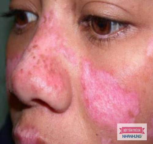 Lupus ban đỏ là bệnh tự miễn