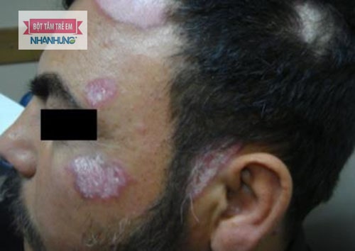 Lupus ban đỏ xuất hiện nhiều trên mũi, má