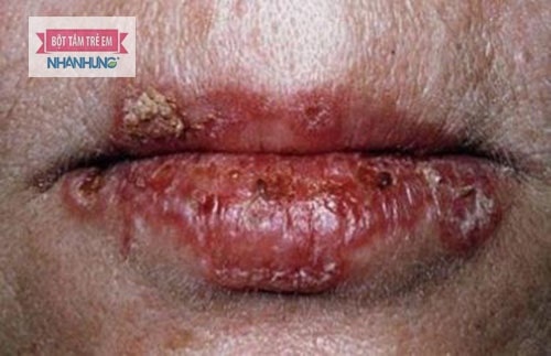 Lupus ban đỏ để lại nhiều di chứng nặng nề với sức khỏe