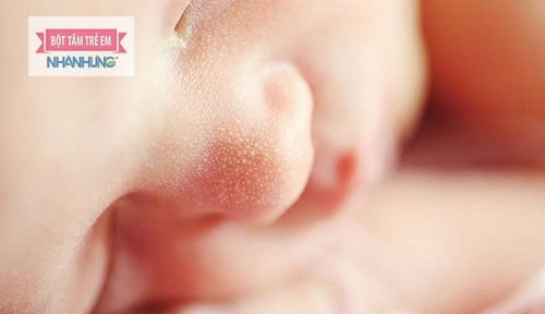 Mụn sữa là những nốt mụn trắng li ti bằng đầu hạt gạo, bên trong có nhân trắng như bã đậu
