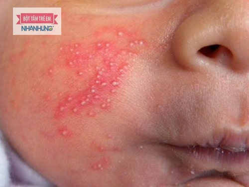 Sữa mẹ là một trong những nguyên nhân khiến trẻ bị mụn sữa