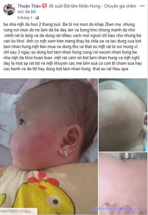 Đang từ làn da mịn màng “chuẩn” da em bé, bỗng nhiên con bị nổi mẩn đỏ khắp 2 bên má, da bong tróc. Mẹ Thuận Thảo đã sử dụng rất nhiều cách nhưng không hết, vậy mà chỉ dùng bộ đôi chàm sữa Nhân Hưng 3 ngày con đã khỏi hoàn toàn