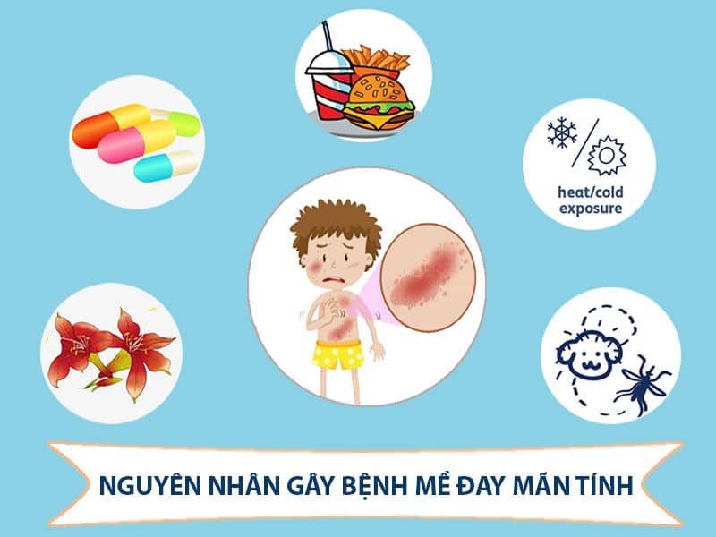 Mề đay mạn tính gây ra bởi nhiều nguyên nhân khác nhau.