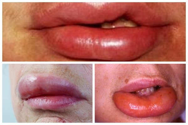 Phù Quincke gây nhiều biến chứng nguy hiểm đối với trẻ.
