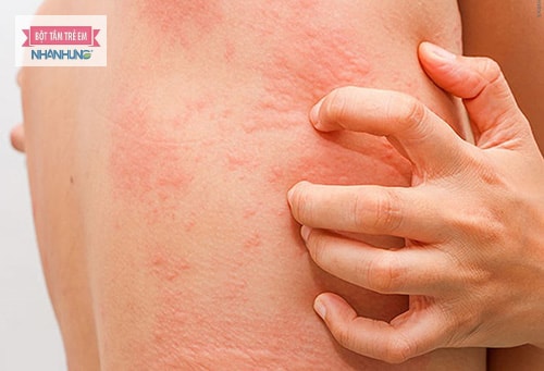 Hiện tượng ngứa toàn thân kéo dài không dứt là biểu hiện của nhiều bệnh lý nguy hiểm.