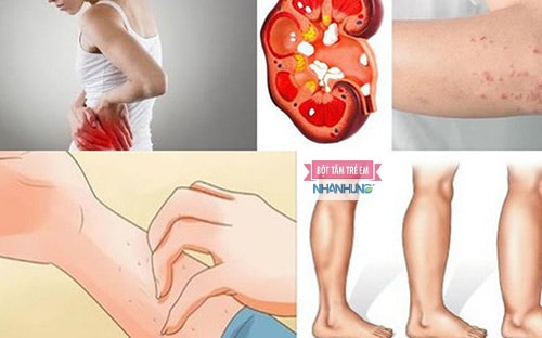 Suy giảm chức năng gan thận cũng có thể gây ngứa toàn thân kéo dài.