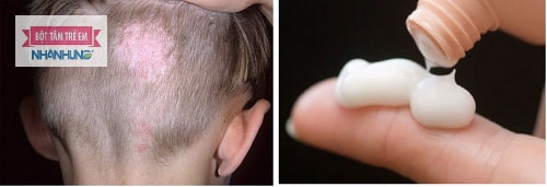 Sử dụng thuốc bôi chứa corticoid để hạn chế viêm da đầu gây rụng tóc.