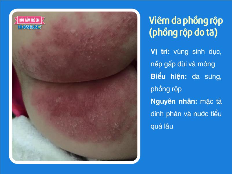 Viêm da phồng rộp (phồng rộp do tã)