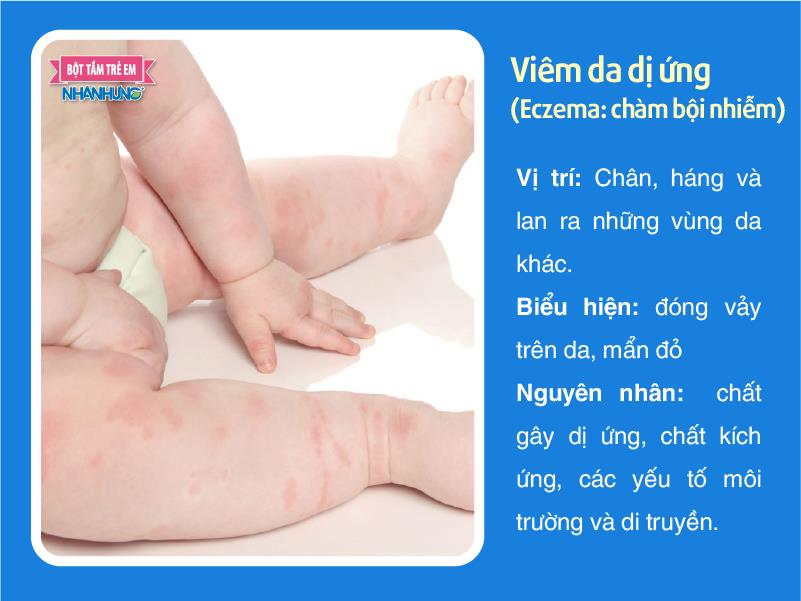 Viêm da dị ứng (Eczema: chàm bội nhiễm)