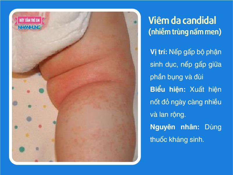 Viêm da candidal (nhiễm trùng nấm men)