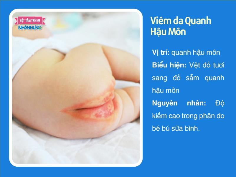 Viêm da quanh hậu môn