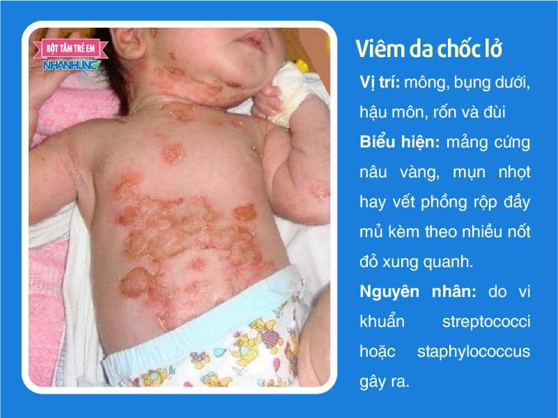 Bệnh chốc lở