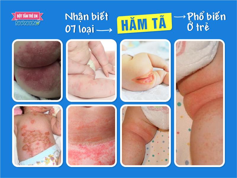 Nhận biết 7 loại  hăm tã phổ biến ở trẻ
