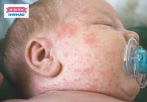 Nhiễm trùng da ở trẻ sơ sinh do xâm nhập của vi khuẩn làm cho các tổn thương trên da.