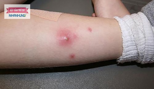 Khử trùng vết thương thúc đẩy hồi phục da do nhiễm trùng nhanh chóng.