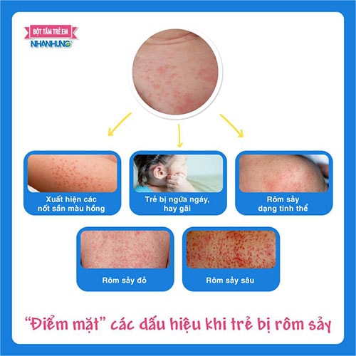 Rôm sảy ở trẻ có nhiều dấu hiệu khác nhau.