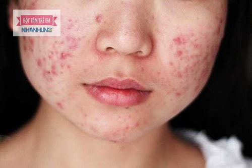Da mặt rất mỏng manh nên dễ bị dị ứng bởi các yếu tố bên ngoài.