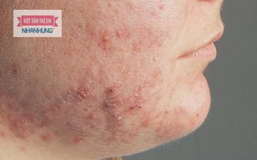 Triệu chứng viêm da dị ứng ở mặt thường là khô sần, mẩn đỏ và ngứa.